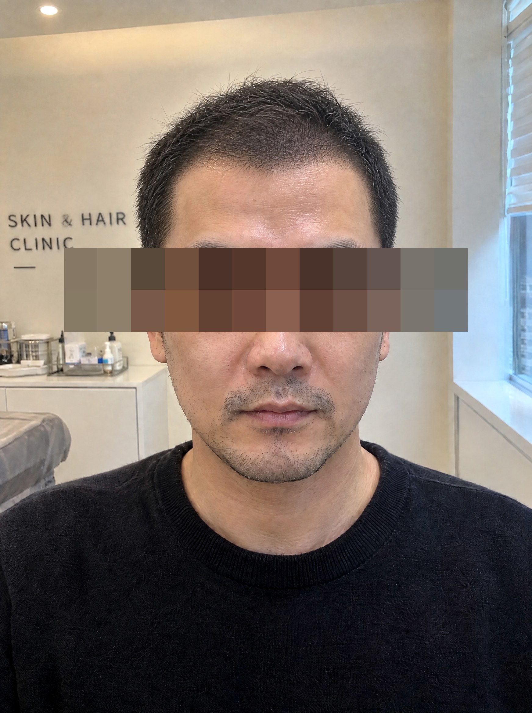 두피문신 시술 후 연출 이미지