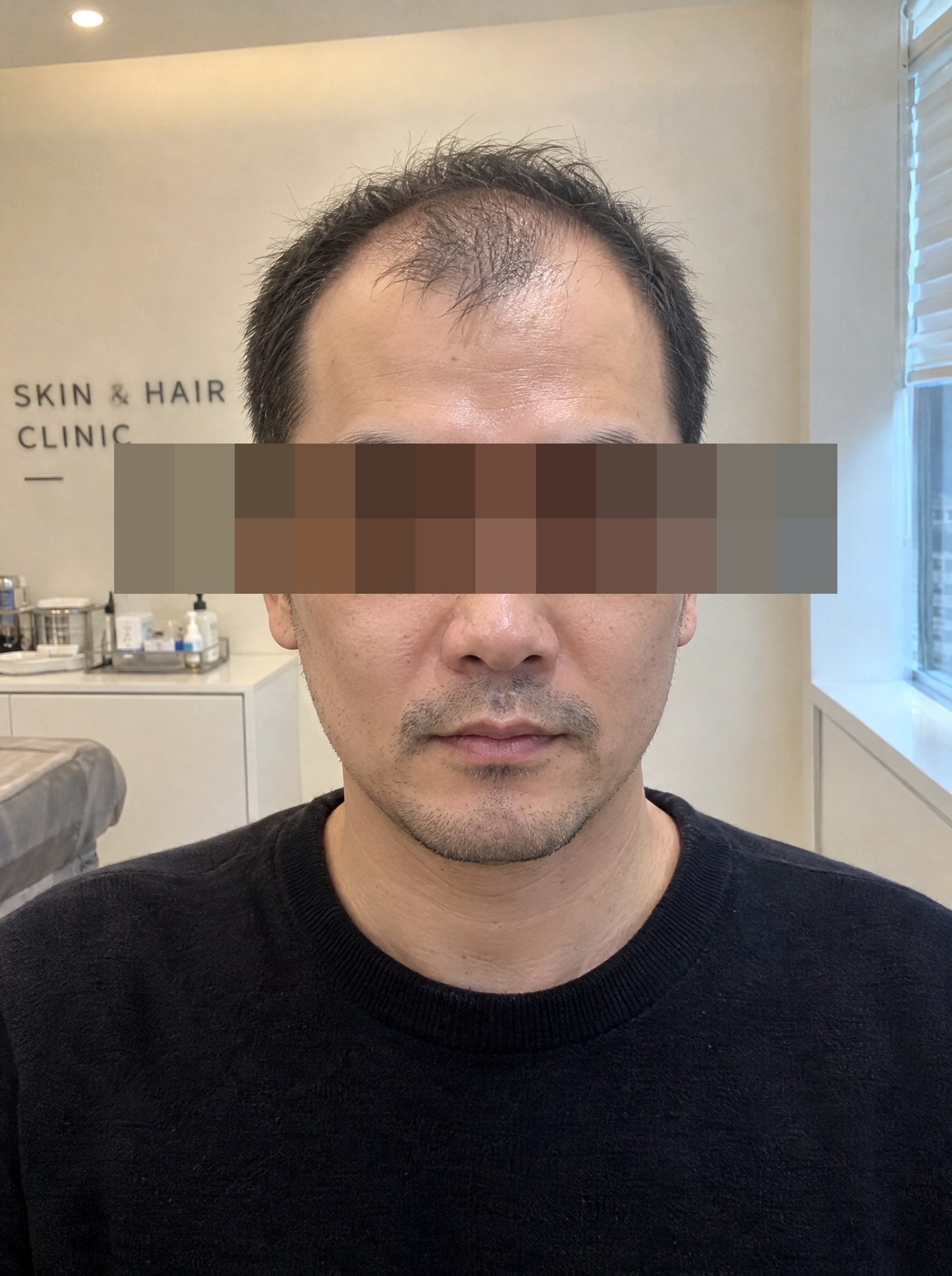 두피문신 시술 전 연출 이미지